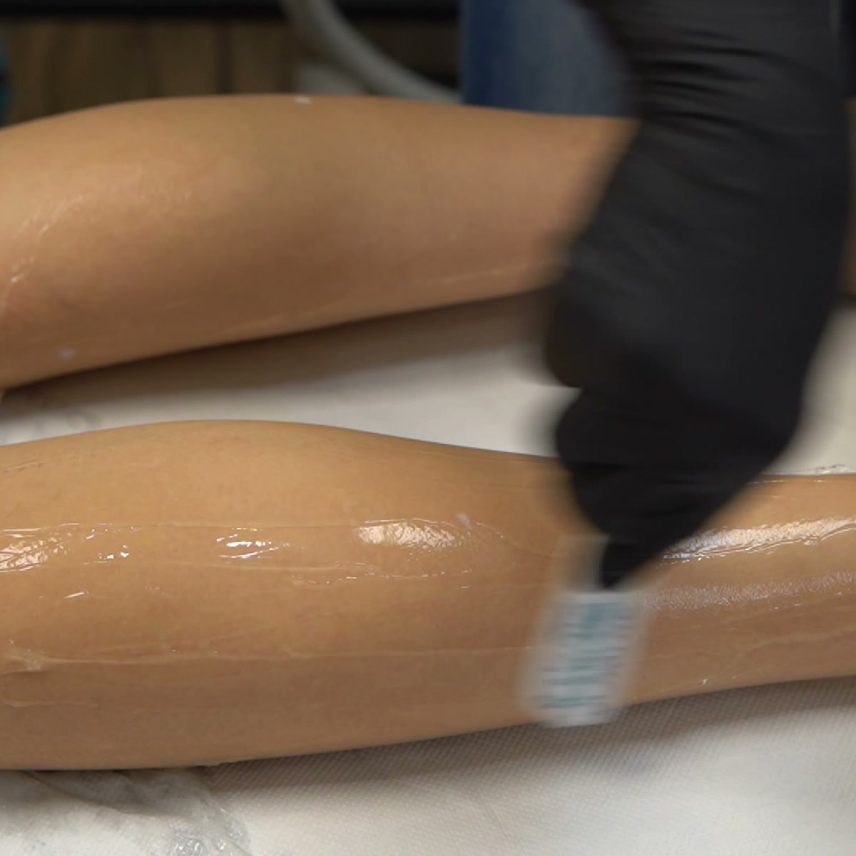 Applying cooling conductive gel to the lower leg before the diode laser treatment